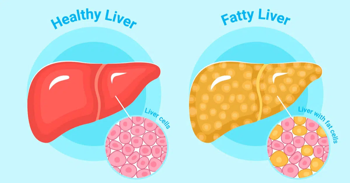 Read more about the article Decode the Signs: Know the Symptoms of Fatty Liver