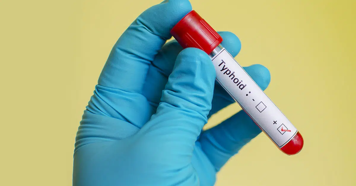The Role of Typhoid Blood Test in Typhoid Treatment